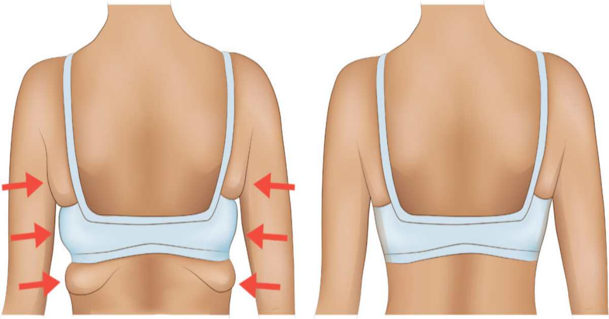7 Exercises to Get Rid of Back and Armpit Fat in 20 Minutes